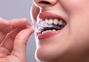 https://www.surreyplacedental.com/wp-content/uploads/2023/02/teeth-alignment-treatment-surrey-bc-300x211.jpg